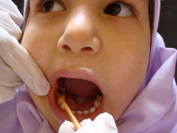 فلورايد تراپي در مهد هاي كودك كاشمر